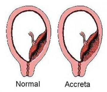 Placenta Accreta